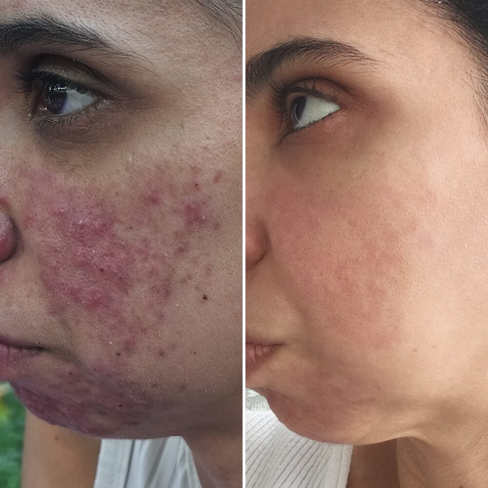 Antes y después del Método Riv®