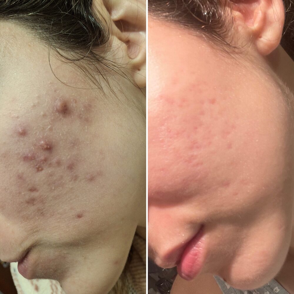Antes y después del Método Riv®